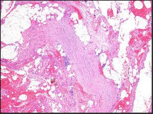 Histology showing thickened and edematous subcutaneous septa. Both the subcutaneous septa and the superficial fascia contain a mixed inflammatory infiltrate (hematoxylin-eosin, original magnification ×100).