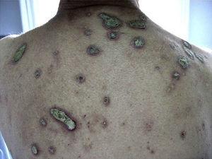 Larger lesions than in Figure 1, in this case on the back of patient 8.