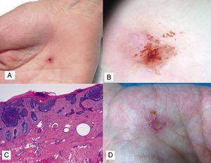 A, Ulcerated lesion with a hemorrhagic crust on the palm. B, Dermoscopic image showing absence of pigmented network and presence of a hemorrhagic crust and shiny white-red areas. C, Nodules of basaloid cells connected to the epidermis at different points, with epidermal thinning and parakeratosis (hematoxylin-eosin, original magnification ×10). D, Ulcerated erythematous palmar plaque in the second patient.