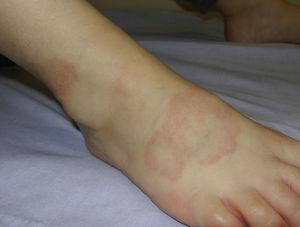 Granuloma annulare: slightly erythematous annular plaques around a pale center on the dorsum of the foot.
