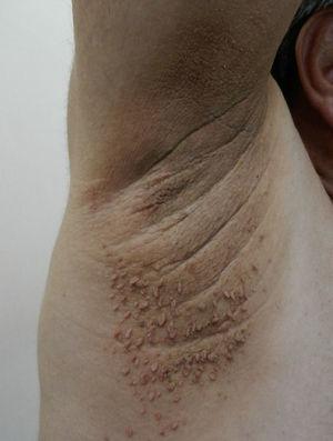 Skin tags: an uncountable number of flesh-colored pedunculated papules in the armpit of a patient who also presented acanthosis nigricans.