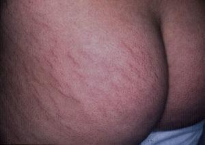 Striae: linear atrophic violaceous plaques on the buttocks.