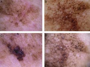 Typical dermoscopic features of lentigo maligna melanoma of the face. A, Asymmetrically pigmented follicular openings and annular-granular pattern. B, Rhomboidal structures. C, Homogeneous facial areas. D, Target structures corresponding to the invasion of the hair follicles by atypical melanocytes (ovoid).