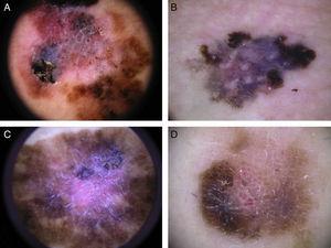 Several dermoscopic characteristics are more common in invasive melanoma than in melanoma in situ. A, Blue-gray, red, and white colors are more common in invasive melanoma. B, A blue-white veil in an invasive melanoma. C, White shiny structures. D, Reverse pigment network.