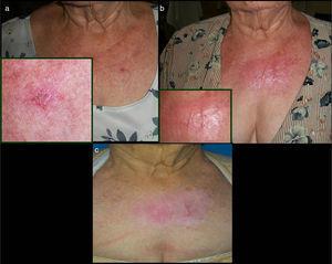 Hypertrophic and Keloid Scars After the Application of 5% Imiquimod ...