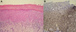 A, Hyperkeratosis, acanthosis, dyskeratosis, and vacuolization of the basal layer, associated with a lichenoid inflammatory infiltrate at the dermoepidermal interface. Keratinocyte disorganization and atypia are also visible. B, Intense expression of p53 in the dysplastic keratinocytes.