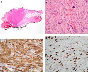 A, Panoramic microscopic image shows a neoplasm with an expansive growth pattern, which does not affect the resection margin (hematoxylin-eosin, original magnification ×4). B, The neoplasm is composed of spindle cells arranged in fascicles with marked atypia and abundant mitotic figures (hematoxylin-eosin, original magnification ×40). C, Expression of smooth muscle actin (Papanicolaou, original magnification ×40). D, The proliferative index (Papanicolaou, Ki-67) is 20%.
