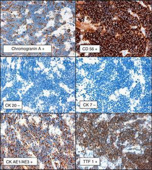 Immunohistochemistry shows that the cells are positive for epithelial and neuroendocrine markers; negativity for cytokeratin (CK) and CK7 associated with positivity for thyroid transcription factor (TTF) 1 helps to exclude other diagnoses such as Merkel cell tumor.