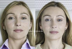 The face appears more rested after botulinum toxin injection in the upper, middle, and lower thirds.