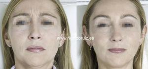 The glabella is more relaxed. The corners of the mouth have also been lifted by the relaxation of the depressor anguli oris muscle.
