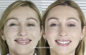 These photographs show the relaxation of the crow's feet, the lifting of the lateral portion of the brow, and an reduction in gingival display.