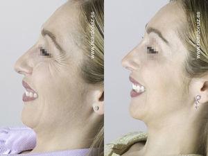 A side view shows the improvement in the crow's feet, the lifting of the nasal tip, and the better-defined jawline.
