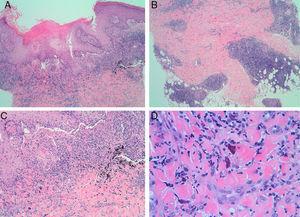Histopathology study of lesions resulting from a granulomatous reaction to a tattoo. Granulomas can be observed in the superficial dermis (A, hematoxylin-eosin [H-E] ×4) and deep dermis (B, H-E ×4). Greater magnification reveals foreign body granulomas around the pigment (C, H-E ×10) and phagocytic cells filled with red pigment (D, H-E ×40).