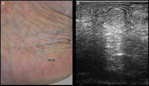 A, Clinical photograph of piezogenic papules in a 52-year-old woman, visible even without weightbearing. Small, round, skin-colored papules/nodules are present on the medial surface of the heel. B, Ultrasound image of a piezogenic papule. An area isoechoic with the underlying subcutaneous cellular tissue is observed within the reticular dermis. There is slight thickening of the dermis.