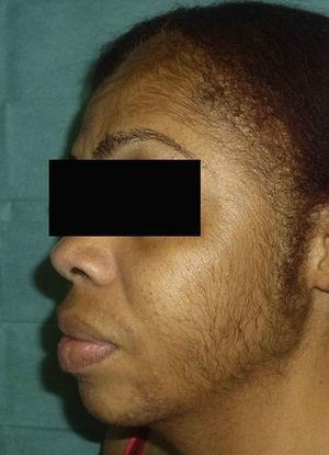 Hypertrichosis on the face with involvement of the forehead, temples, cheeks, and beard area.
