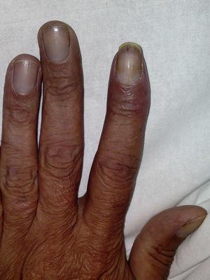 Erythema on the second finger of the left hand.