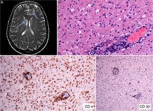 A, Diffuse white matter signal abnormality, especially in the frontal and periventricular regions (arrows). B, Brain tissue biopsy showing a predominantly perivascular lymphoid infiltrate (hematoxylin-eosin, ×200). C, Immunohistochemical staining showing the CD4+ lymphocytic infiltrate in brain tissue (CD4, ×100). D, Expression of CD30 antigen in sparse lymphoid cells of brain tissue (CD30, ×40).
