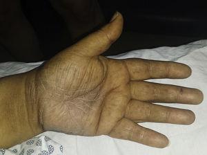 Mnohočetné hyperpigmentované makuly na dlani levé ruky.