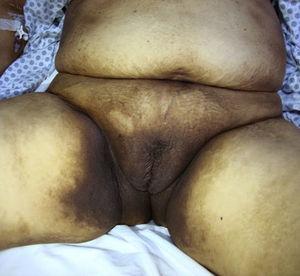Hiperpigmentación extensa en zonas intertriginosas con afectación genital, perineal e inguinal.