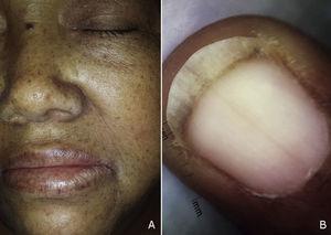 A, Macule iperpigmentate sul viso e sul labbro superiore e inferiore. B, immagine dermoscopica di melanonichia che colpisce l'unghia.