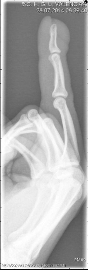 Nodule in contact with soft tissue. No bone involvement is observed on the radiograph.