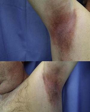 Resolution of axillary lesions following a single photodyamic therapy session.