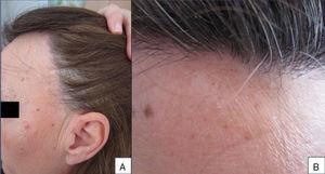 A,Bilateral and symmetric recession of the frontal and temporal hairline with thinning and partial loss of eyebrow hair, especially in the distal third. B,Absence of associated erythema or hyperkeratosis.