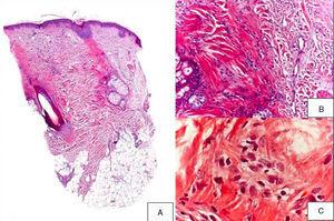 A,Presence of fibrosis replacing and destroying the follicle, and absence of epidermal involvement (hematoxylin-eosin, original magnification × 10). B,Difference between follicular fibrosis and normal, interwoven collagen fibers (hematoxylin-eosin, original magnification × 40). C,Absence of lymphocytic infiltrate. Presence of elevated numbers of mast cells (hematoxylin-eosin, original magnification × 200).