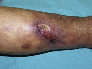 Skin ulcer accompanied by livedo racemosa caused by calciphylaxis.