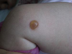 Solitary mastocytoma located on the thigh. A friction-induced tense blister containing clear liquid.