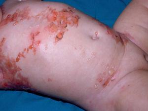 Diffuse cutaneous mastocytosis in an infant. Spontaneous formation of vesicles and blisters triggered by rubbing.
