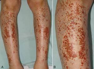 (A) Clinical features of purpuric lesions on the right and left shin. (B) Close-up view.