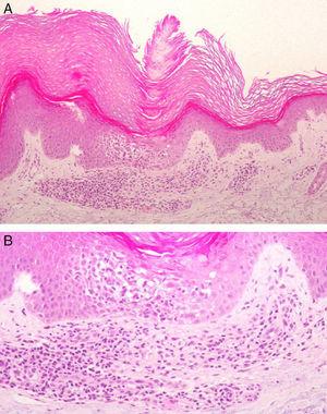 Inflammatory Disseminated Pruritic Porokeratosis With a Good Response ...