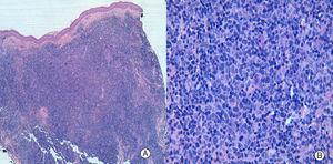 A, The low-power image shows a dense dermal infiltrate that extends into the subcutaneous cellular tissue but shows no epidermotropism. Hematoxylin and eosin, original magnification ×4. B, The infiltrate is formed mainly of small- and medium-sized pleomorphic lymphocytes. Hematoxylin and eosin, original magnification ×40.