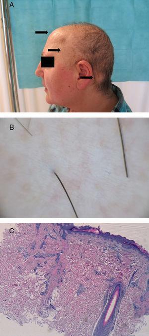 A, Plaques of alopecia (arrows) in the midfrontal and left temporal and retroauricular areas. B, Dermoscopic image of retroauricular area. Loss of follicular orifices. C, Histology of a biopsy from the retroauricular area. A preserved hair follicle with a lichenoid infiltrate and vertical tract of scar-tissue left by the destruction of a follicle. Hematoxylin and eosin, original magnification ×4).