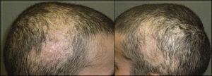 Bilateral parietal and temporal alopecic plaques.