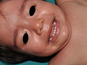 Juvenile xanthogranulomas on the eyebrow tail and the medial angle of the right eye, and nevus anemicus in the left clavicular region in a patient aged 15 months.