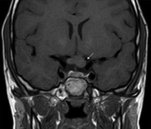 Optic nerve glioma. T1-weighted coronal magnetic resonance imaging. Circumferential thickening of the left optic chiasm is observed (arrow), consistent with optic nerve glioma.