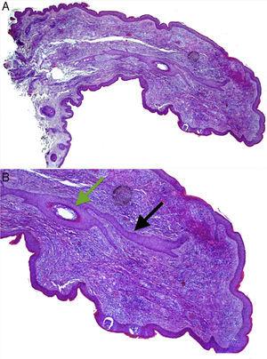 (A) Histopathology of the papule located on the columella. Hematoxylin and eosin, original magnification 20×. (B) A central hair follicle (green arrow) with anastomosing bands of follicular epithelium extending from the central hair follicle into the adjacent stroma (black arrows), compatible with a fibrofolliculoma. Hematoxylin and eosin, original magnification 100×.