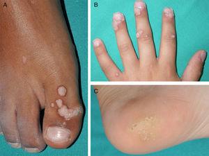 Common warts of differing morphology in different parts of the body in pediatric patients. Choice of treatment will be determined by the number of lesions on the dorsum of the toe (A), the periungual location (B), and the size of the warts on the heel (C).