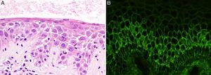 Histology images: A, Detail of neutrophilic spongiosis. Hematoxylin and eosin, original magnification ×40. B, Intercellular deposits of immunoglobulin G (direct immunofluorescence).