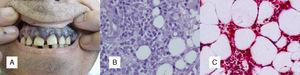 A. Encías violáceas, edematosas, con sangrado ocasional. B. Infiltración tumoral del tejido celular subcutáneo (hematoxilina-eosina, aumento original ×100).C. La muestra fue positiva para lisozima. gr1.