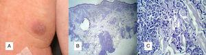 A. Garçon de deux ans présentant des nodules brun-érythémateux apparus sur le tronc et le visage deux semaines auparavant. B. Infiltration tumorale du tissu cellulaire sous-cutané (hématoxyline-éosine, grossissement original ×100).C. Coloration immunohistochimique positive pour le lysozyme. gr2.