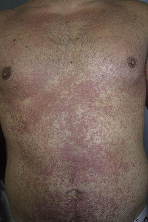 Reactivation of Skin Lesions After Patch Testing to Investigate Drug ...