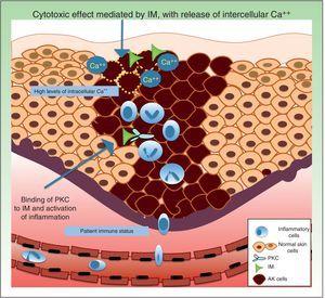 Mechanisms possibly involved in resistance to IM treatment are intracellular Ca++ levels, at the level of receptor binding and immune status of the patient. AK indicates actinic keratosis; Ca++, calcium; IM, ingenol mebutate, PKC, protein kinase C.