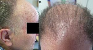 A E B, alopecia androgenética, grau Hamilton VI. ao examinar uma faixa de pele mais fina sem folículos capilares foi encontrada em ambos os templos. Tanto o eritema como a hipererqueratose folicular foram evidentes na testa e no topo da cabeça.