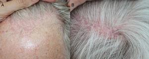  A, zurückgehender Haaransatz mit Erythem und perifollikulärer Hyperkeratose. B, Flecken von parietaler Narbenbildung Alopezie typisch für follikulären Lichen planus.