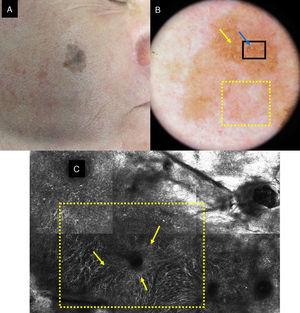A, Facial polychrome macule of 3 years duration on a 68-year-old man. B, Dermoscopic image with asymmetric follicular openings (yellow arrow), increased vascular density (yellow square), and brown rhomboid structures (blue arrow). C, RCM image corresponding to the area of the 1×1.5mm black square in the dermoscopic image, showing abundant dendritic cells (yellow square) with follicular localization. To the left of the image, loss of the honeycomb pattern is observed in the spinous cell layer; to the right, the image corresponds to the horny layer.
