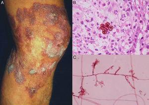 A, Cromoblastomicosis nodular-verrugosa. B, Biopsia que muestra células fumagoides. C, Examen directo del cultivo de Fonsecaea pedrosoi (biopsia; hematoxilina-eosina y eritrosina 2%, aumento original en ambos casos ×40).