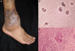 A, 足の放線菌腫. B、直診で見られたノカルジア属の顆粒（KOH、原倍率10倍）。 C, 生検（ヘマトキシリン・エオジン×40）